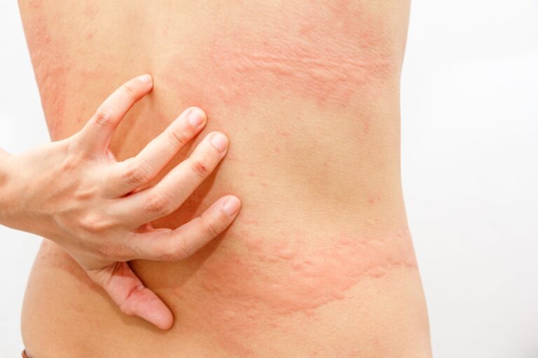 Orticaria